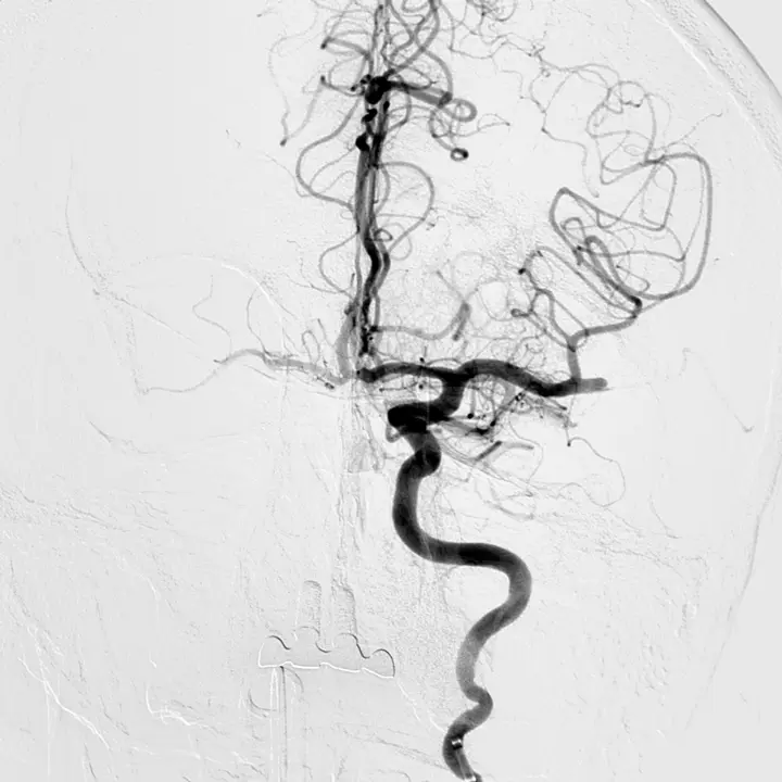 FOTO NP ICTUS_Imagen de arteria obstruida con trombo_Fotor