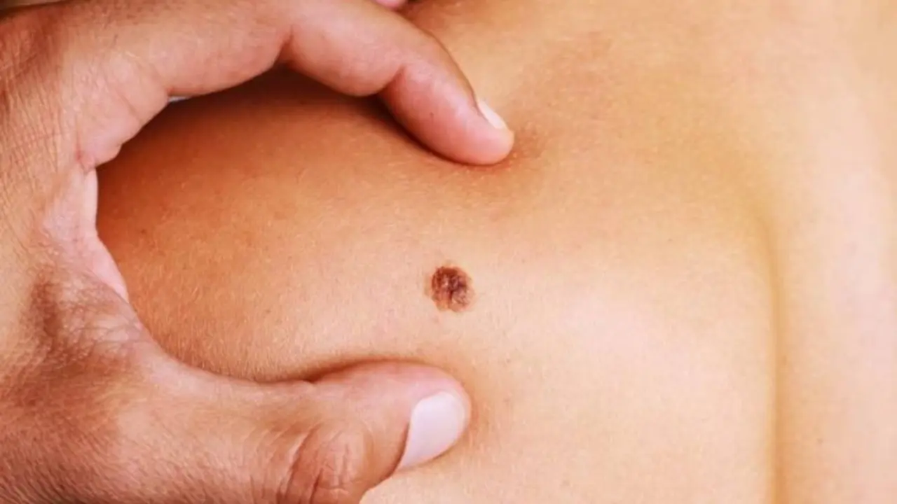 C&aacute;ncer piel melanoma Fotor