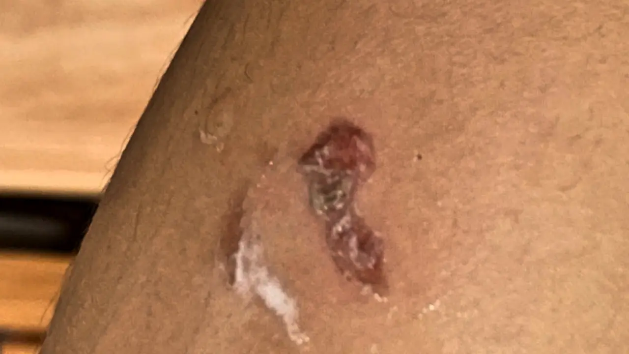 Pustula causada por sarna -53 4(1)