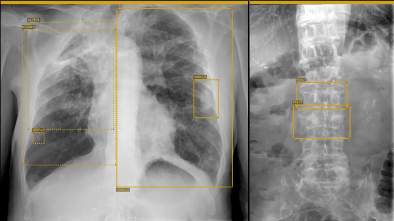 Radiograf&Atilde;&shy;as analizadas por la inteligencia artificial(1)